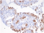 IHC staining of FFPE human renal carcinoma tissue with SREBF2 antibody (clone SREBP2/1580) at 2ug/ml in PBS for 30min RT. HIER: boil tissue sections in pH 9 10mM Tris with 1mM EDTA for 20 min and allow to cool before testing.