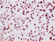 IHC staining of FFPE human epithelioid sarcoma tissue with INI1 antibody (clone SMARCB1/3984). HIER: boil tissue sections in pH 9 10mM Tris with 1mM EDTA for 20 min and allow to cool before testing.
