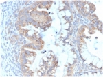 IHC staining of FFPE human colon carcinoma tissue with IL-7 antibody (clone IL7/4013). HIER: boil tissue sections in pH 9 10mM Tris with 1mM EDTA for 20 min and allow to cool before testing.