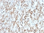 IHC staining of FFPE human colon carcinoma tissue with IL-25 antibody (clone IL25/625). HIER: boil tissue sections in pH 9 10mM Tris with 1mM EDTA for 20 min and allow to cool before testing.