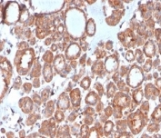 IHC staining of FFPE human thyroid tissue with Calcitonin antibody (clone CALCA/3310). HIER: boil tissue sections in pH 9 10mM Tris with 1mM EDTA for 20 min and allow to cool before testing.