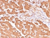IHC staining of FFPE human colon carcinoma tissue with Aldehyde Dehydrogenase 1A1 antibody (clone ALDH1A1/4793). HIER: boil tissue sections in pH 9 10mM Tris with 1mM EDTA for 20 min and allow to cool before testing.