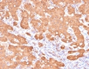 IHC staining of FFPE human colon carcinoma tissue with Aldehyde Dehydrogenase 1A1 antibody (clone ALDH1A1/4793). HIER: boil tissue sections in pH 9 10mM Tris with 1mM EDTA for 20 min and allow to cool before testing.