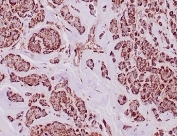 IHC staining of FFPE human breast carcinoma tissue with Aldehyde Dehydrogenase 1A1 antibody (clone ALDH1A1/4793) at 2ug/ml. HIER: boil tissue sections in pH 9 10mM Tris with 1mM EDTA for 20 min and allow to cool before testing.