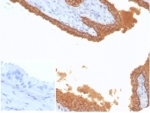 IHC staining of FFPE human prostate carcinoma tissue with recombinant Prostate Specific Antigen antibody (clone KLK3/7128R) at 2ug/ml. Negative control inset: PBS instead of primary antibody to control for secondary binding. HIER: boil tissue sections in pH 9 10mM Tris with 1mM EDTA for 20 min and allow to cool before testing.
