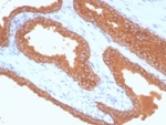 IHC staining of FFPE human prostate carcinoma tissue with recombinant Prostate Specfic Antigen antibody (clone KLK3/7128R). HIER: boil tissue sections in pH 9 10mM Tris with 1mM EDTA for 20 min and allow to cool before testing.