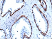 IHC staining of FFPE human prostate tissue with CK14 antibody (clone KRT14/4130) at 2ug/ml. HIER: boil tissue sections in pH 9 10mM Tris with 1mM EDTA for 20 min and allow to cool before testing.