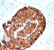 IHC staining of FFPE human testicular carcinoma with recombinant INHA antibody (clone rINHA/6919) at 2ug/ml in PBS for 30min RT. HIER: boil tissue sections in pH 9 10mM Tris with 1mM EDTA for 20 min and allow to cool before testing.