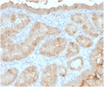 IHC staining of FFPE human thyroid carcinoma tissue with LGALS3 antibody (clone LGALS3/4792). HIER: boil tissue sections in pH 9 10mM Tris with 1mM EDTA for 20 min and allow to cool before testing.