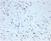 IHC staining of FFPE human rhabdomyosarcoma tissue with recombinant MYOG antibody (clone rMYOG/6297). HIER: boil tissue sections in pH 9 10mM Tris with 1mM EDTA for 20 min and allow to cool before testing.