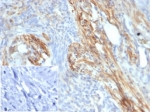 IHC staining of FFPE human bladder carcinoma tissue with PIK3 antibody (clone PIK3R2/292). Negative control inset: PBS used instead of primary antibody to control for secondary Ab binding.