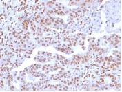 IHC staining of FFPE human colon carcinoma tissue with NFIA antibody (clone PCRP-NFIA-2C6). HIER: boil tissue sections in pH 9 10mM Tris with 1mM EDTA for 20 min and allow to cool before testing.
