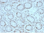 IHC staining of FFPE human colon carcinoma tissue with SOX4 antibody (clone PCRP-SOX4-1D6). HIER: boil tissue sections in pH 9 10mM Tris with 1mM EDTA for 20 min and allow to cool before testing.