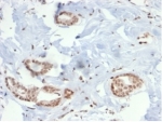 IHC staining of FFPE human breast carcinoma tissue with SOX4 antibody (clone PCRP-SOX4-1D6). HIER: boil tissue sections in pH 9 10mM Tris with 1mM EDTA for 20 min and allow to cool before testing.