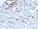IHC staining of FFPE human rhabdomyosarcoma tissue with MEF2D antibody (clone PCRP-MEF2D-3A4). HIER: boil tissue sections in pH 9 10mM Tris with 1mM EDTA for 20 min and allow to cool before testing.