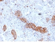 IHC staining of FFPE human melanoma tissue with NGFR/TNFRSF16 antibody (clone NGFR/4919) at 2ug/ml. HIER: boil tissue sections in pH 9 10mM Tris with 1mM EDTA for 20 min and allow to cool before testing.