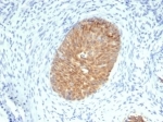 IHC staining of FFPE human cervical squamous cell carcinoma with MASPIN Antibody (clone SERPINB5/4975). HIER: boil tissue sections in pH 9 10mM Tris with 1mM EDTA for 20 min and allow to cool before testing.