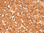 IHC staining of FFPE human pituitary tumor tissue with ACTH antibody (clone rCLIP4278). HIER: boil tissue sections in pH 9 10mM Tris with 1mM EDTA for 20 min and allow to cool before testing.