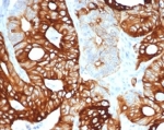 IHC staining of FFPE human colon carcinoma tissue with recombinant KRT20 antibody (clone KRT20/4380R). HIER: boil tissue sections in pH 9 10mM Tris with 1mM EDTA for 20 min and allow to cool before testing.