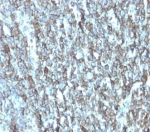 IHC staining of FFPE human breast carcinoma tissue with Migfilin-1 antibody (clone FBLIM1/4600) at 2ug/ml. HIER: boil tissue sections in pH 9 10mM Tris with 1mM EDTA for 20 min and allow to cool before testing.