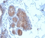 IHC staining of FFPE human breast carcinoma tissue with Migfilin-1 antibody (clone FBLIM1/4600) at 2ug/ml. HIER: boil tissue sections in pH 9 10mM Tris with 1mM EDTA for 20 min and allow to cool before testing.