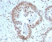IHC staining of FFPE human prostate carcinoma tissue with ZNF704 antibody (clone PCRP-ZNF704-3C10). HIER: boil tissue sections in pH 9 10mM Tris with 1mM EDTA for 20 min and allow to cool before testing.