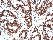 IHC staining of FFPE human colon carcinoma tissue with Ku80 antibody (clone XRCC5/7317). HIER: boil tissue sections in pH 9 10mM Tris with 1mM EDTA for 20 min and allow to cool before testing.