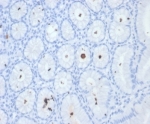IHC staining of FFPE H. pylori-infected human stomach tissue with Helicobacter pylori antibody (clone HPYL/7226). HIER: boil tissue sections in pH 9 10mM Tris with 1mM EDTA for 20 min and allow to cool before testing.