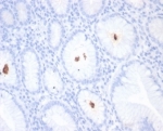 IHC staining of FFPE H. pylori-infected human stomach tissue with Helicobacter pylori antibody (clone HPYL/7227). HIER: boil tissue sections in pH 9 10mM Tris with 1mM EDTA for 20 min and allow to cool before testing.