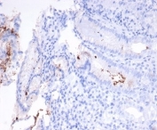 IHC staining of H. pylori-infected FFPE human stomach tissue with Helicobacter pylori antibody (clone HPYL/7227). HIER: boil tissue sections in pH 9 10mM Tris with 1mM EDTA for 20 min and allow to cool before testing.
