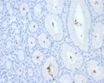 IHC staining of FFPE H pylori-infected human stomach tissue with Helicobacter pylori antibody (clone HPYL/7228). HIER: boil tissue sections in pH 9 10mM Tris with 1mM EDTA for 20 min and allow to cool before testing.