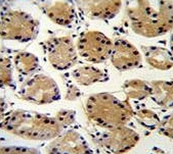 FAT10 Antibody Human Stomach Carcinoma IHC. IHC staining of FFPE human stomach carcinoma tissue with FAT10 antibody demonstrated moderate to strong cytoplasmic staining in malignant epithelial cells, consistent with the expression pattern of FAT10 (Ubiquitin D, UBD), a ubiquitin-like modifier involved in proteasomal degradation, immune regulation, and inflammatory signaling. FAT10 expression is induced by pro-inflammatory cytokines including interferon-Î³ and TNF-Î± and has been reported to be elevated in several human malignancies, where it may contribute to tumor progression, altered protein homeostasis, and immune responses within the tumor microenvironment. The observed staining supports the utility of FAT10 Antibody for studies of cancer biology, inflammation, and ubiquitin-like protein conjugation. Immunohistochemistry was performed on formalin-fixed, paraffin-embedded human stomach carcinoma tissue.