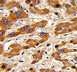 IHC analysis of FFPE human hepatocarcinoma stained with Bax antibody