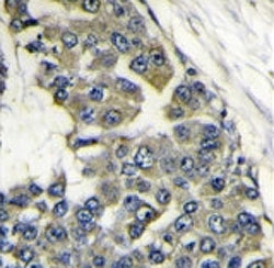 IHC analysis of FFPE human breast carcinoma stained with EIF4B antibody