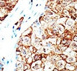 IHC analysis of FFPE human breast carcinoma tissue stained with the Ubiquilin1 antibody