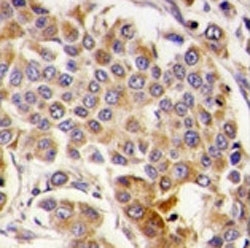 IHC analysis of FFPE human breast carcinoma tissue stained with AMPK antibody