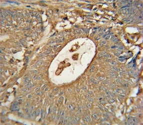 ACOX1 antibody immunohistochemistry analysis in formalin fixed and paraffin embedded human colon carcinoma