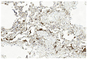 LAMP2 Antibody in Human Lung Tissue IHC. Immunohistochemistry staining of paraffin-embedded human lung tissue with LAMP2 Antibody demonstrates heterogeneous brown DAB staining within the lung parenchyma, with granular cytoplasmic positivity visible in scattered cells. This staining pattern is consistent with the lysosomal and vesicular localization of LAMP2. The antibody was used at a 1:500 dilution followed by a biotinylated goat polyvalent secondary antibody and DAB detection. Hematoxylin counterstaining highlights nuclei and surrounding lung architecture.