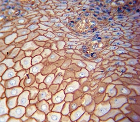CD44 Antibody Esophagus Carcinoma IHC. Immunohistochemistry analysis of CD44 / CD44 antigen expression in FFPE human esophagus carcinoma tissue using mouse monoclonal antibody clone Hermes-3. Strong membranous HRP-DAB brown staining is observed in malignant epithelial cells, outlining cell borders and highlighting cell surface localization consistent with CD44 expression. The staining pattern demonstrates cohesive tumor architecture and supports its use for evaluating epithelial organization and CD44-associated cell surface interactions in esophageal carcinoma tissue. Heat induced epitope retrieval was performed by boiling tissue sections in pH 9 10mM Tris with 1mM EDTA for 20 min followed by cooling at RT before testing.