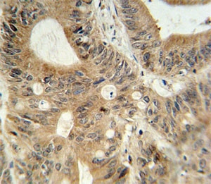 ABCC3 antibody immunohistochemistry analysis in formalin fixed and paraffin embedded human colon carcinoma.