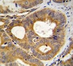 TRPM8 antibody immunohsitochemistry analysis in formalin fixed and paraffin embedded human prostate carcinoma.