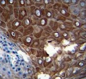 Fibroblast Collagenase Antibody Human Esophageal Carcinoma IHC. Immunohistochemistry analysis of FFPE human esophageal carcinoma tissue using Fibroblast Collagenase Antibody. Strong cytoplasmic and membranous staining is observed in malignant epithelial cells, consistent with MMP1 expression associated with extracellular matrix remodeling and tumor progression. These results support the use of Fibroblast Collagenase Antibody for studying collagen degradation, stromal remodeling and cancer-associated extracellular matrix regulation.