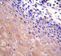 GCLC antibody immunohistochemistry analysis in formalin fixed and paraffin embedded human esophageal carcinoma.