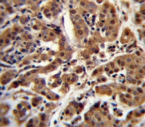 AKT antibody immunohistochemistry analysis in formalin fixed and paraffin embedded human breast carcinoma