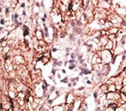 LSD1 Antibody Breast Carcinoma IHC. Immunohistochemistry analysis of FFPE human breast carcinoma tissue stained with the LSD1 antibody.