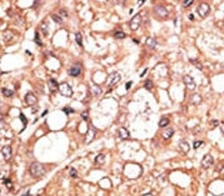 LSD1 Antibody Hepatocarcinoma IHC. Immunohistochemistry analysis of FFPE human hepatocarcinoma stained with the LSD1 antibody.