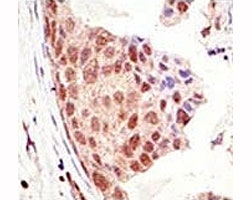 IHC analysis of FFPE human breast carcinoma tissue stained with the SUMO antibody