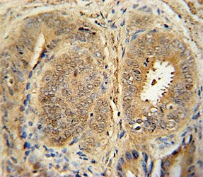 Anti-MDM2 antibody immunohistochemistry analysis in formalin fixed and paraffin embedded human prostate cancer.