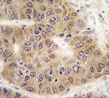 IHC analysis of FFPE human hepatocarcinoma tissue stained with SUMO4 antibody