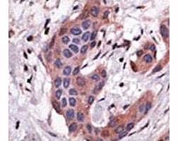 IHC analysis of FFPE human breast carcinoma tissue stained with the Bid antibody